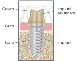 Dental Implants in Bay City