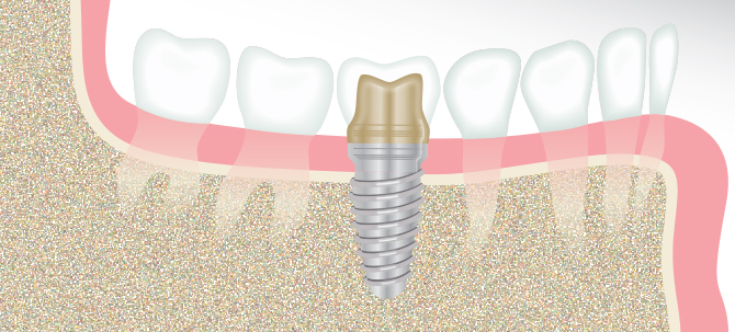 Dental Implants in Bay City