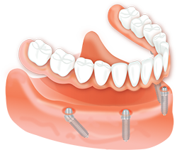 Dental Implants in Bay City